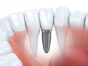dental implants Lacey