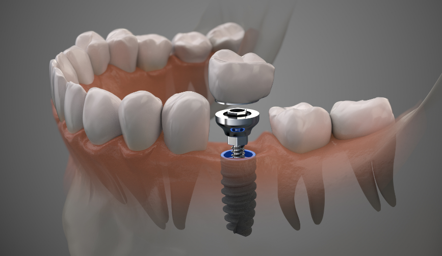 3D image of a dental implant