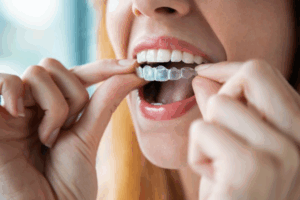 Woman inserting a SureSmile tray